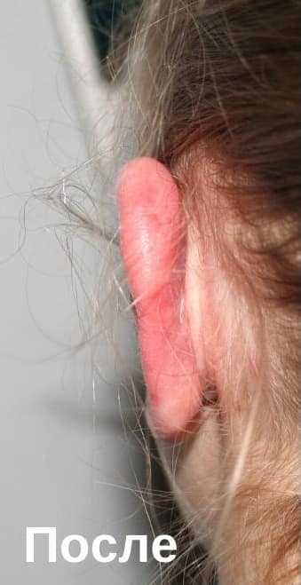Отопластика: після операції. Хірург Віктор Родін