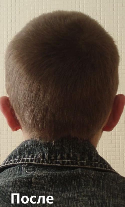 Отопластика: після операції. Хірург Віктор Родін