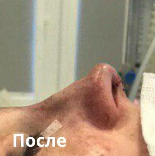 Ринопластика: після операції. Хірург Віктор Родін